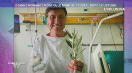 Gianni Morandi mostra le mani sui social dopo le ustioni thumbnail