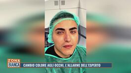 Cambio colore agli occhi, l'allarme dell'esperto thumbnail