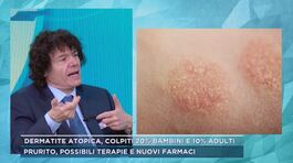Dermatite atopica, colpiti 20% bambini e 10% adulti thumbnail