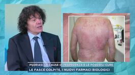 Psoriasi, le cause di insorgenza e le possibili cure thumbnail