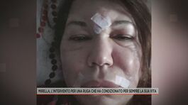 Mirella, l'intervento per una ruga che ha condizionato per sempre la sua vita thumbnail