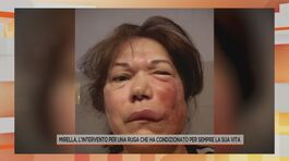 Mirella, l'intervento per una ruga che ha condizionato per sempre la sua vita thumbnail