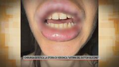 Chirurgia estetica, la storia di Veronica "Vittima del dottor silicone"