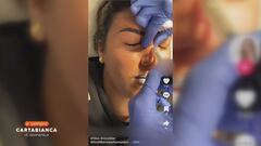 Il fenomeno degli Interventi di rinofiller e rinoplastica attraverso i social