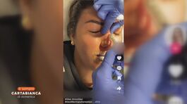 Il fenomeno degli Interventi di rinofiller e rinoplastica attraverso i social thumbnail