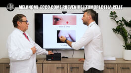 PECORARO: Melanomi: ecco come prevenire i tumori della pelle thumbnail