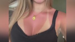 L'ultima follia dei teenagers, abbronzatura selvaggia da ustione thumbnail