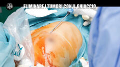 PECORARO: Eliminare i tumori con il ghiaccio