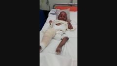 Disabili in Kenya, le gambe di Victor sono tornate diritte